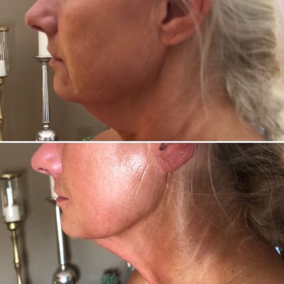 Before and After results for facial tightening massage on one of our clients