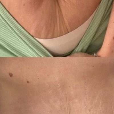 Before and after skin tightening on the stomach area for one of our clients.