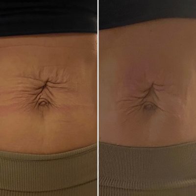 Before and after skin tightening on the belly button area for one of our clients.