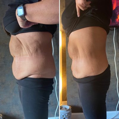 Before and after skin tightening on the belly area for one of our clients.