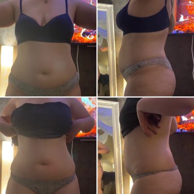 Instant results shown in before and after photos of one of our stunning clients stomach areas