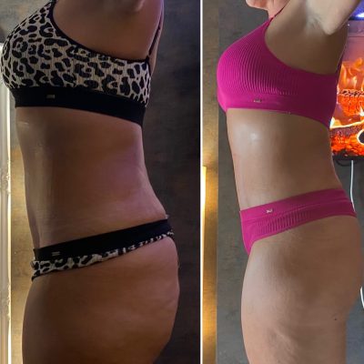 Before after after results on one of our stunning client's body.