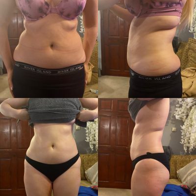 Instant results shown in before and after photos of one of our clients stomach areas